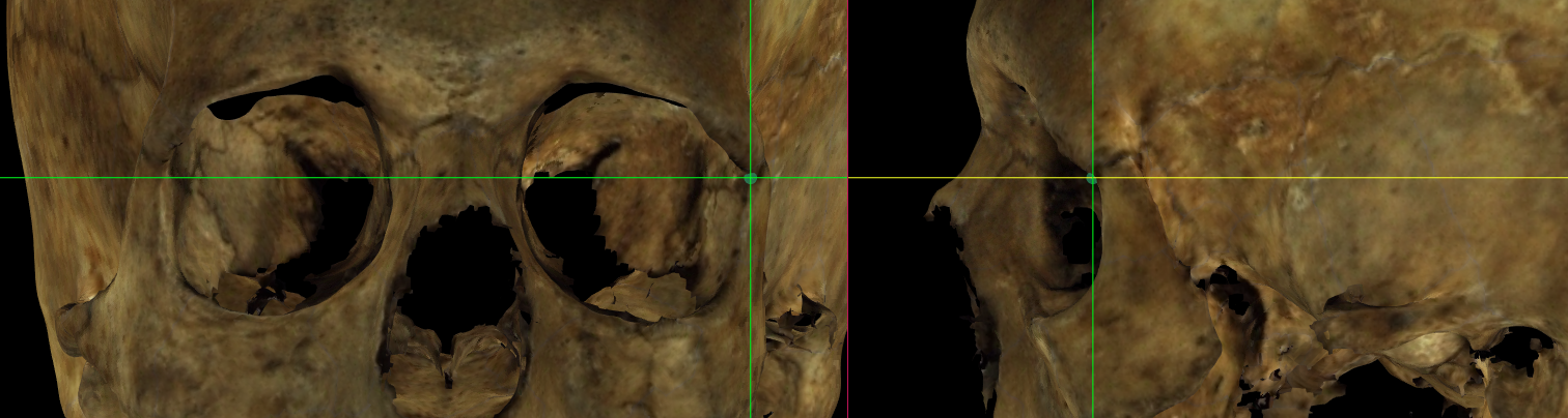 Imagen ampliada mostrando frontomalare orbitale (izquierdo) en un modelo 3D de un cráneo en Norma Frontalis y Norma Lateralis