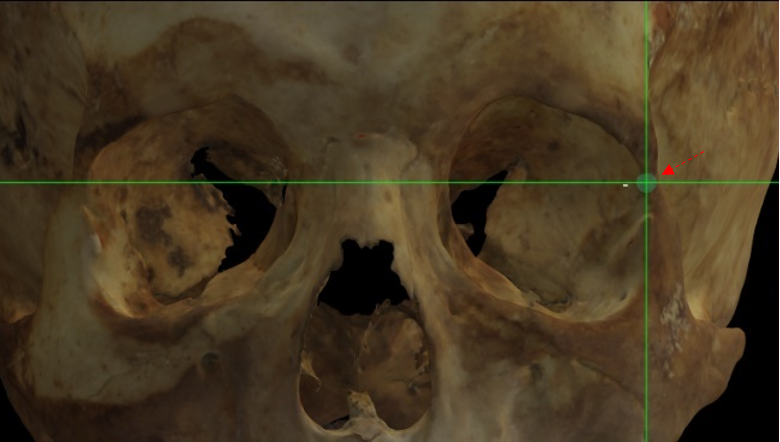 Imagen ampliada mostrando el frontomalare orbitale (izquierdo) estimado en el modelo 3D de un cráneo con una baja definición de la sutura en Norma Frontalis y Norma Lateralis